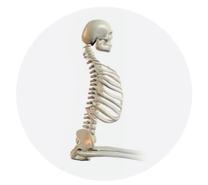 Anterior Pelvic Tilt with Hyperlordosis